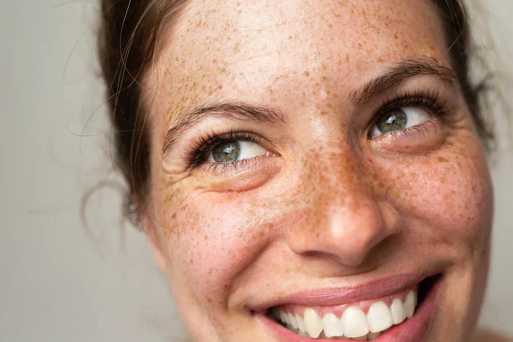 Tudo sobre manchas de sol: causas, prevenção e tratamentos Retrato alegre de uma mulher com sardas, sorrindo e exibindo dentes brancos e saudáveis, destacando a beleza natural e a autenticidade.