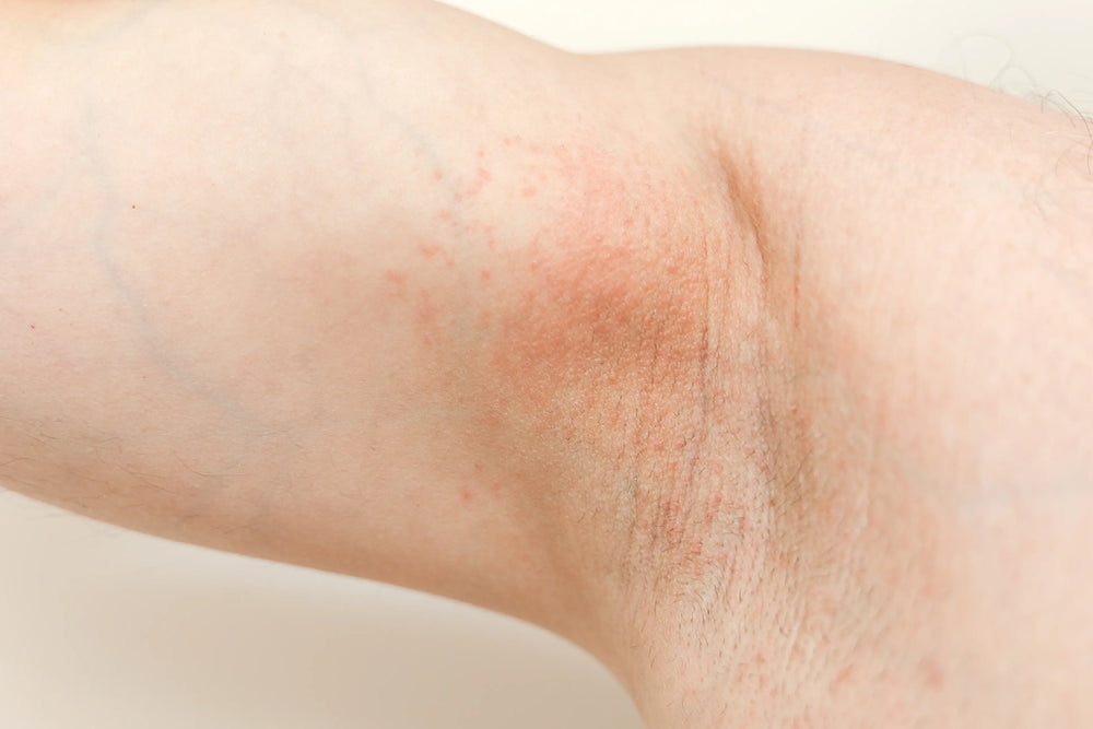Imagem do braço humano com pele clara, destacando áreas de tonalidade irregular. Observam-se marcas e textura da pele.