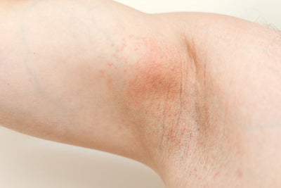 Imagem do braço humano com pele clara, destacando áreas de tonalidade irregular. Observam-se marcas e textura da pele.