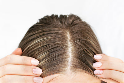 Como prevenir caspa e manter o couro cabeludo saudável?