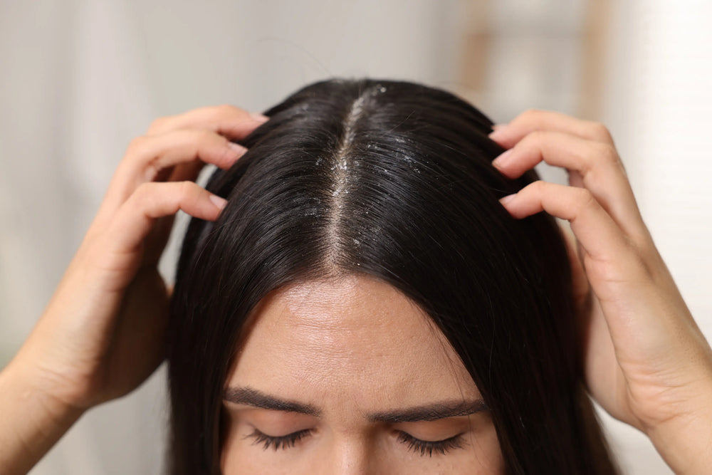Mulher com cabelo liso e escuro, massageando o couro cabeludo, evidenciando a preocupação com a saúde capilar e o combate à caspa.