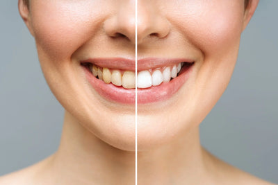 Imagem mostrando o contraste entre dentes manchados e dentes brancos brilhantes, ilustrando a importância do clareamento dental para um sorriso saudável.