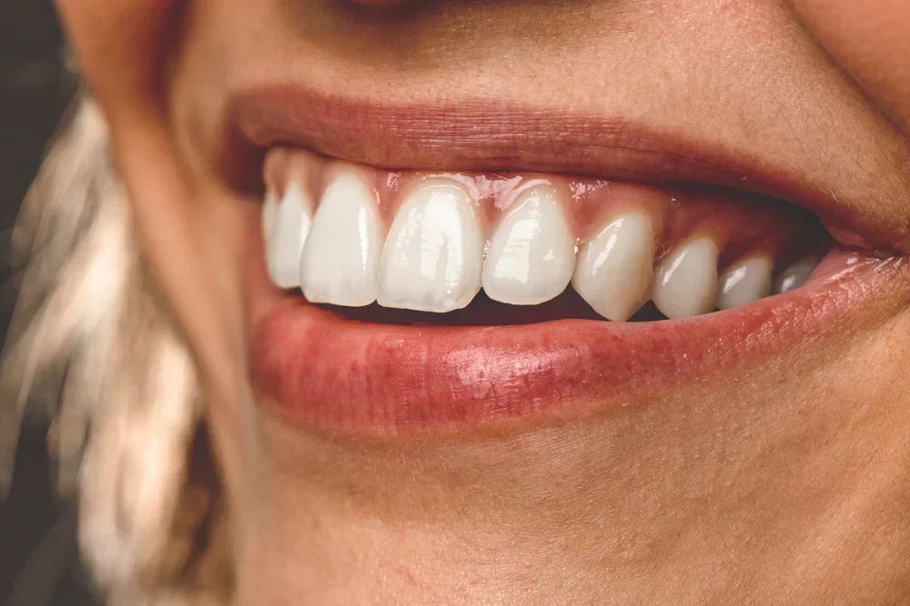 Imagem de um sorriso com dentes brancos e saudáveis, destacando a importância da saúde bucal e de cuidados dentários adequados.