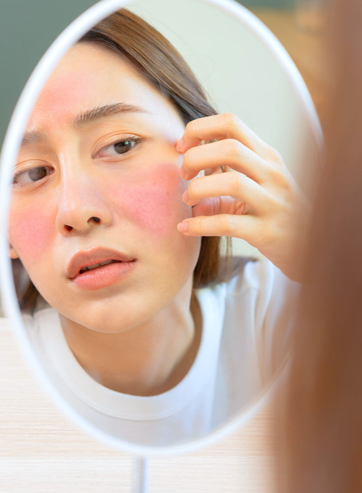 O que é rosácea? Conheça as causas, tipos e tratamento!