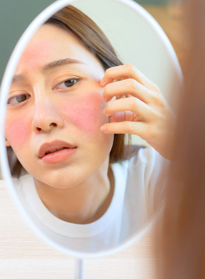 O que é rosácea? Conheça as causas, tipos e tratamento!
